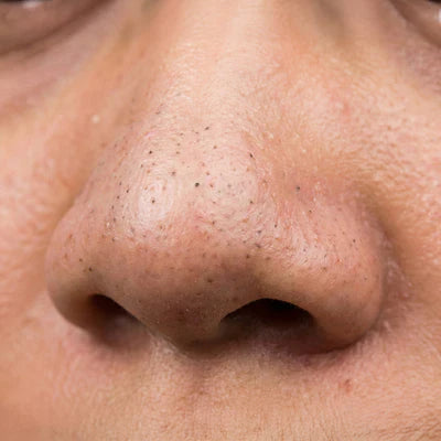 Blackheads